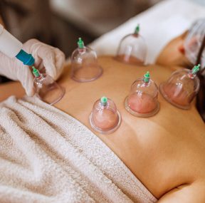 16554-cupping-therapy